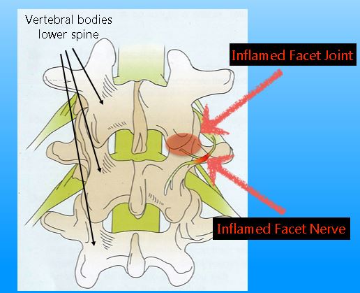 Facet Joint Injections | Interventional Pain Management Center