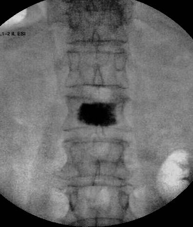 Kyphoplasty Image
