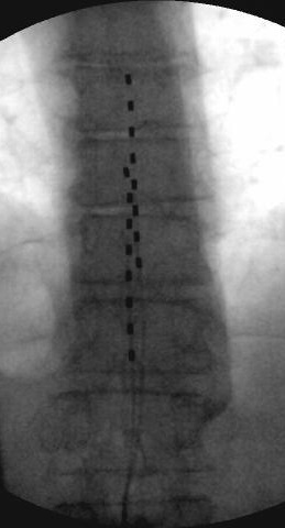 Spinal Cord Stimulators Image