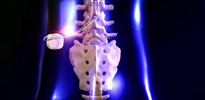 What Lawyers Should Know About Spinal Cord Stimulators - OAS