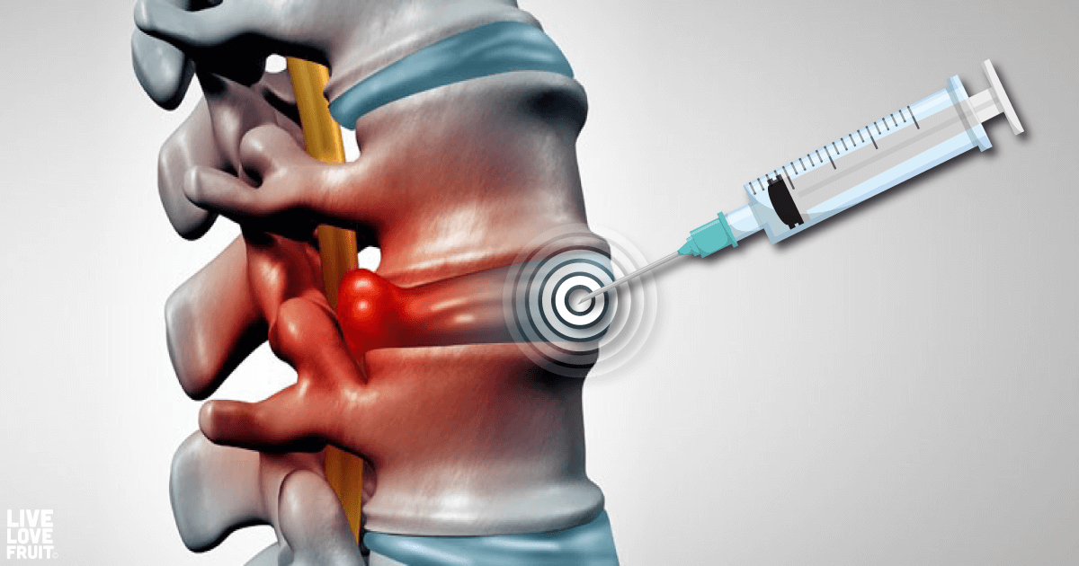 Epidurals Interventional Pain Management Center